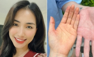 Làm mẹ bỉm, Hòa Minzy hết bị rạn bụng lại lo lắng khi bị vàng da tay