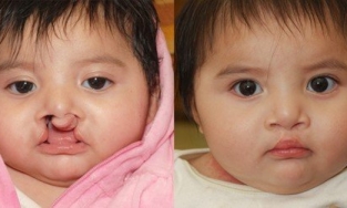  Phẫu thuật hở hàm ếch: 'Phẫu thuật thẩm mỹ' mang lại nụ cười cho trẻ