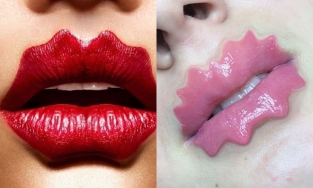 Trào lưu tiêm filler tạo dáng môi 'quái lạ': Đẹp hay kì dị?