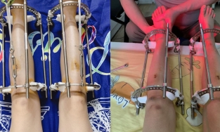 Cô gái chia sẻ hành trình phẫu thuật kéo dài chân thêm 7cm lên TikTok