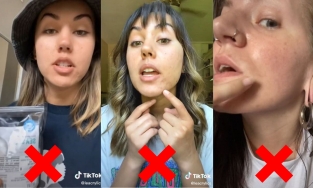 Chuyên gia khuyên bạn không nên thử trị mụn theo 5 cách này trên TikTok