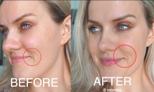 CÔNG NGHỆ THERMAGE - BÍ QUYẾT CHO MỘT LÀN DA KHÔNG TUỔI