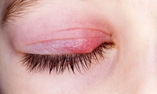 Làm thế nào để loại bỏ mụn trên mí mắt?