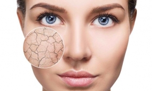 Cách chăm sóc da khô thiếu nước giúp cấp ẩm nhanh và hiệu quả nhất cho da