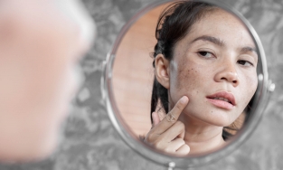 Top 5 cách trị nám nắng đơn giản mà hiệu quả ngay tại nhà bạn nên thử