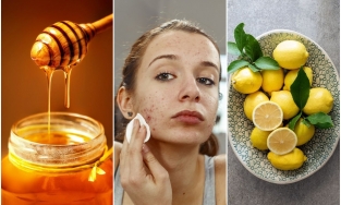 Bỏ túi ngay 7 cách trị mụn tại nhà nhanh nhất trong 1 ngày hiệu quả