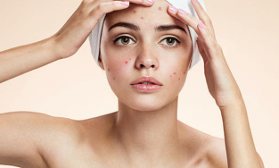 Bật mí 4 loại sản phẩm tẩy trang tốt nhất dành cho da mụn