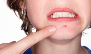 Bí kíp nặn mụn đúng cách, không để lại thâm ai cũng cần biết