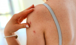 Cách để bạn thoát khỏi mụn lưng một lần và mãi mãi