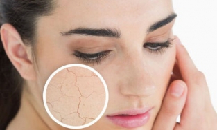 Đây là cách khắc phục da khô sần, thiếu nước trong những ngày đông