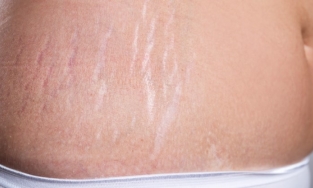 Cách phòng ngừa và điều trị các vết rạn da tại nhà