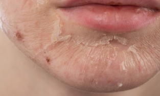 Tình trạng lột da là gì? Nguyên nhân và cách điều trị hiệu quả