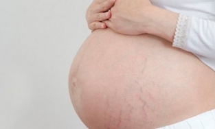 Rạn da khi mang thai: Nguyên nhân và cách phòng ngừa