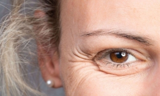 Nguyên nhân gây ra vết chân chim và cách ngăn ngừa