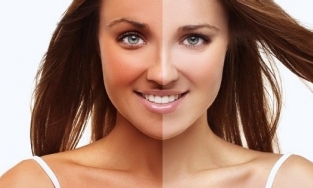 Các biện pháp khắc phục tại nhà để thoát khỏi tình trạng rám nắng