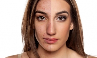 8 lời khuyên về chăm sóc da mụn viêm từ chuyên gia