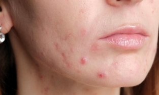 Cách trị mụn bọc tại nhà hiệu quả ai cũng cần biết