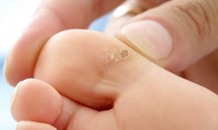 4 cách trị mụn cóc đơn giản, hiệu quả nhanh chóng