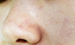 Bật mí cách chăm sóc da dầu mụn lỗ chân lông to hiệu quả nhất