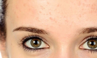 Khắc tinh của mụn trán - những cách trị mụn trên trán hiệu quả