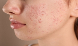 Cách trị mụn trứng cá hiệu quả ai cũng nên ghi chú