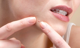 Có nên nặn mụn hay không? Tại sao?