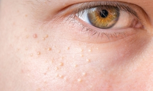 Bật mí cách trị mụn thịt hiệu quả không phải ai cũng biết