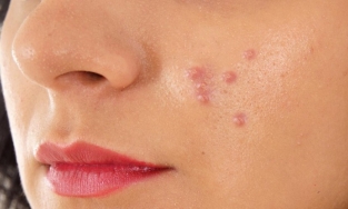 Cách trị mụn mủ: Sai một li, đi một dặm