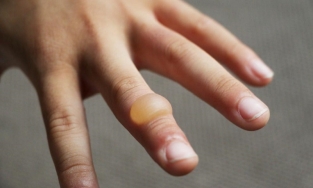 Hướng dẫn cách trị mụn nước hiệu quả