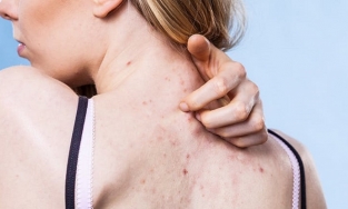 5 cách trị mụn lưng hiệu quả từ chuyên gia da liễu