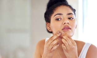Cách trị mụn ở cằm do nội tiết tố mà bạn nên biết