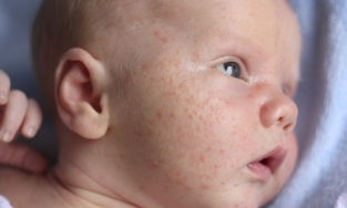 Cách trị mụn sữa ở trẻ sơ sinh các mẹ cần biết