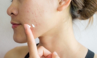 4 cách trị mụn thâm tại nhà hiệu quả giúp làn da sạch mụn, đều màu