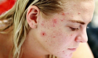 Cách trị mụn nội tiết tố bằng cách điều chỉnh chế độ ăn uống