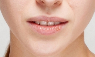 Môi xinh mọc mụn: Đâu là cách trị mụn ở môi nhanh nhất