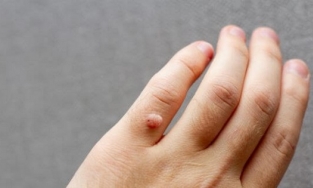 Bật mí cách trị mụn cơm hữu hiệu