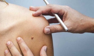 Các cách trị mụn ruồi tại nhà có hiệu quả và an toàn không?