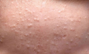 Bạn đã biết những cách trị mụn ẩn tại nhà này chưa?