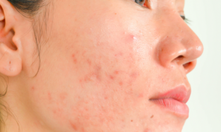 Bỏ túi những cách trị mụn viêm sưng đỏ cực kỳ hiệu quả