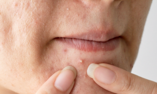 Cách trị mụn trắng hiệu quả cần ghi chú ngay