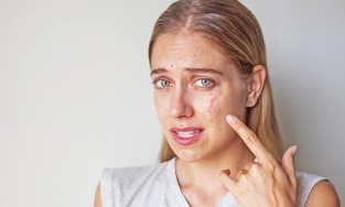 Tổng hợp những cách trị mụn mặt hiệu quả