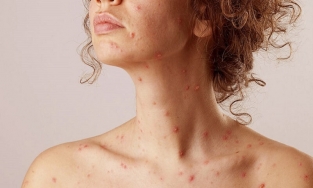 Mẹo nhỏ giúp bạn chăm sóc da sau khi bị thủy đậu