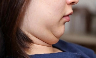 Bạn nên ăn gì để giảm mỡ mặt hiệu quả?