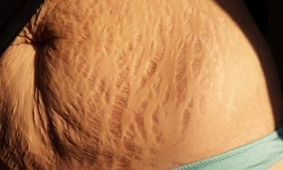 Làm thế nào để hạn chế rạn da? 