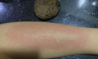 Cô gái bị dị ứng và bong da do tẩy da chết bằng đá