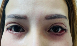 Cảnh báo: Cắt mí sai cách, đôi mắt của cô gái 25 tuổi trở nên vô cùng đáng sợ