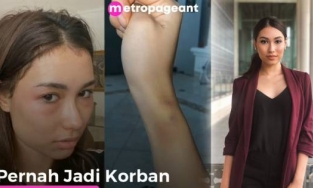 Hoa hậu Hoàn vũ Indonesia bị bỏng mặt do làm da tại viện thẩm mỹ