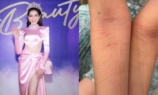 1 giờ đi sự kiện của Đỗ Thị Hà: Đằng sau hình ảnh hoàn hảo, nụ cười rạng rỡ là hai cánh tay rướm máu