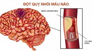 Dấu hiệu cảnh báo đột quỵ