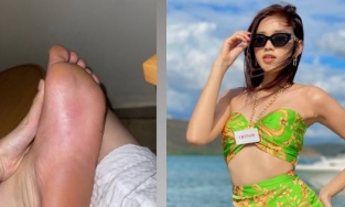 Đỗ Thị Hà bị ong chích sưng chân trong phần thi Người đẹp biển